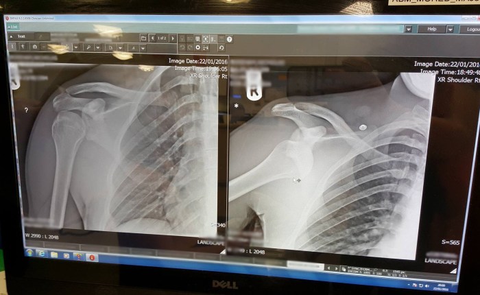 Dislocations 101: Tawe to&nbsp;A&E